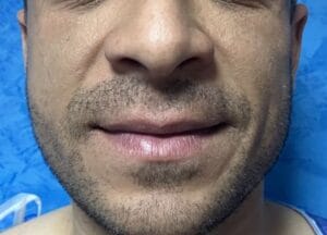 Thin tapering face with jowls and treated by nanofat grafting at Best Plastic Surgery Egypt