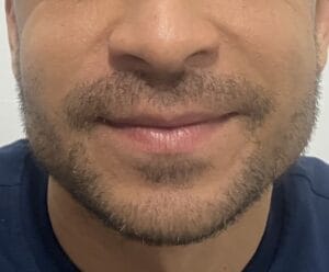 Thin tapering face treated by nanofat grafting to enhance jawline and cheeks at Best Plastic Surgery Egypt