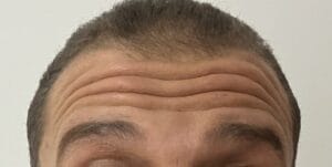 Nanofat transfer for deep forehead lines and glabellar wrinkles as a substitute for Botox at Best Plastic Surgery Egypt