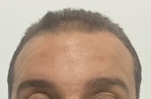 Nanofat transfer for deep forehead lines and glabellar wrinkles as a substitute for Botox at Best Cosmetic Surgery Egypt