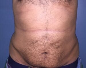 Smart high Definition 4-Dimensional Liposculpture for Belly and 4-packs at Best Plastic Surgery Egypt