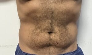Smart high Definition 4-Dimensional Liposculpture for Belly and 4-packs at Best Aesthetic Surgery Egypt