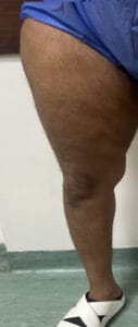 Extensive Smart Vaser Thigh Liposuuction to remove 9 liters of fat at Best Plastic surgery Egypt