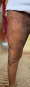Extensive Smart Vaser Thigh Liposuuction to remove 9 liters of fat at Best Cosmetic surgery Egypt