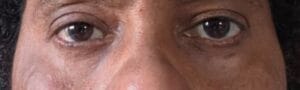 Blepharoplasty through Inside of the Lower Eyelid to Remove Eyelid Bags at Best Aesthetic Surgery Egypt