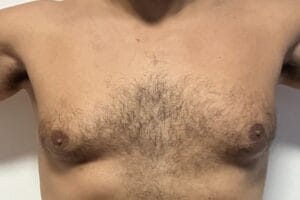High Definition Vaser and Disc Removal for secondary Male Chest Enlargement Gynecomastia at Best Plastic Surgery Egypt