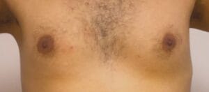 High Definition Vaser and Disc Removal for secondary Male Chest Enlargement Gynecomastia at Best Cosmetic Surgery Egypt
