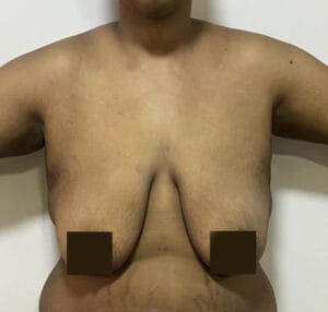 Mastopexy and Fat Grafting for Sagging Breasts with empty upper pole at Best Plastic Surgery Egypt