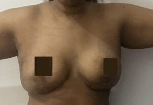 Mastopexy and Fat Grafting for Sagging Breasts with empty upper pole at Best Aesthetic Surgery Egypt