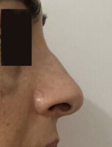 Dorsal hump rhinoplasty and tip Definition by Closed Rhinoplasty at Best Rhinoplasty Surgery Egypt