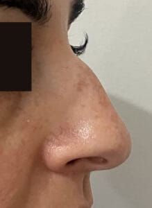 Dorsal hump rhinoplasty and tip Definition by Closed Rhinoplasty at Best Plastic Surgery Egypt