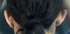 Asymmetric protruding bat ears treated by Otoplasty Ear Reduction at Best Plastic Surgery Egypt