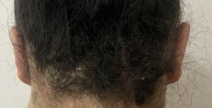 Asymmetric protruding bat ears treated by Otoplasty Ear Reduction at Best Cosmetic Surgery Egypt