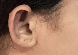 Asymmetric protruding bat ears treated by Otoplasty Ear Reduction at Best Aesthetic Surgery Egypt