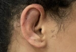 Asymmetric protruding cupping ears treated by Otoplasty Ear Reduction at Best Plastic Surgery Egypt