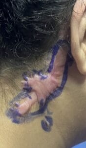 Recurrent Keloid treated by removal and skin graft and 5 Fluorouracil at Best Plastic Surgery Egypt