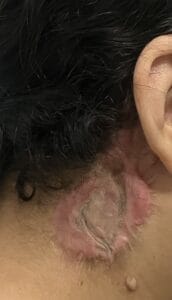Recurrent Keloid treated by removal and skin graft and 5 Fluorouracil at Best Cosmetic Surgery Egypt