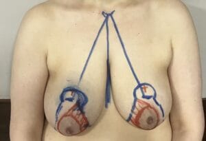 Sagging breasts with ptosis and asymmetry treated by Breast Lift Mastopexy at Best Aesthetic Surgery Egypt
