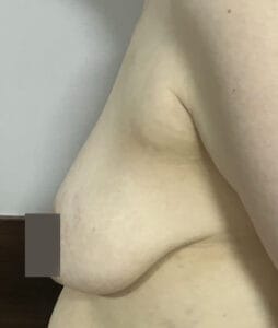 Asymmetric Sagging breasts with ptosis treated by Breast Lift Mastopexy at Best Plastic Surgery Egypt