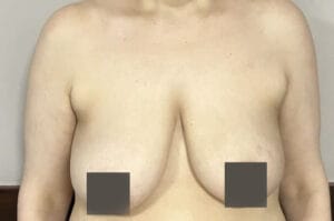 Sagging breasts with ptosis and asymmetry treated by Breast Lift Mastopexy at Best Plastic Surgery Egypt