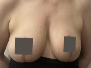 Sagging breasts with ptosis and asymmetry treated by Breast Lift Mastopexy at Best Cosmetic Surgery Egypt