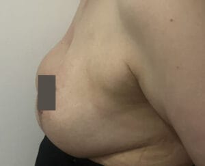 Asymmetric Sagging breasts with ptosis treated by Breast Lift Mastopexy at Best Cosmetic Surgery Egypt