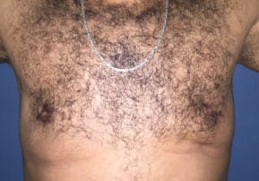 Secondary Gynecomastia Surgery and male chest correction with Fat grafts at Best Cosmetic Surgery Egypt