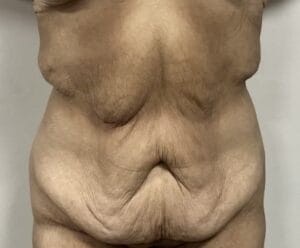 Secondary Tummy Tuck Abdominoplasty with muscle tightening and Vaser Liposculpture at Best Plastic Surgery Egypt