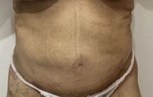 Secondary Tummy Tuck Abdominoplasty with muscle tightening and Vaser Liposculpture at Best Cosmetic Surgery Egypt