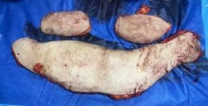 Secondary Tummy Tuck Abdominoplasty with muscle tightening and Vaser Liposculpture at Best Aesthetic Surgery Egypt