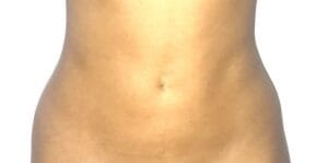 360 liposculpture of the tummy, belly, waist and flanks at Best Cosmetic Surgery Egypt