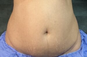 360 liposculpture of the tummy, belly, waist and flanks at Best Plastic Surgery Egypt