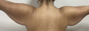 Redundant sagging arms treated by Arm Lift Brachioplasty at Best Plastic Surgery Egypt