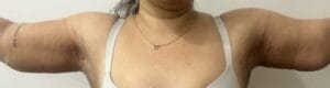 Redundant sagging arms treated by Arm Lift Brachioplasty at Best Cosmetic Surgery Egypt
