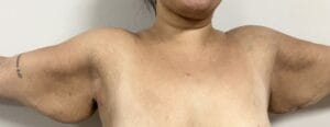 Redundant sagging arms treated by Arm Lift Brachioplasty at Best Aesthetic Surgery Egypt