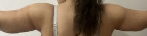 Redundant sagging arms treated by Arm Liposuction and Brachioplasty at Best Plastic Surgery Egypt