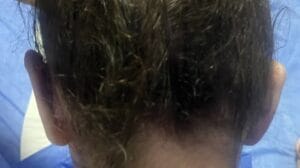 Cupping and Protruding Bat Ears for Otoplasty at Best Cosmetic Surgery Egypt