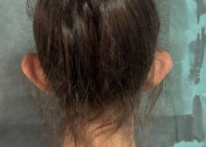 Cupping and Protruding Bat Ears for Otoplasty at Best Plastic Surgery Egypt