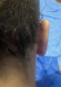 Cupping and Protruding Bat Ears for Ear Pinning Surgery at Best Plastic Surgery Egypt