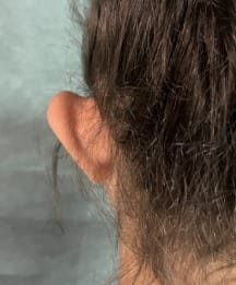 Protruding Bat Ears for Ear Pinning Surgery at Best Cosmetic Surgery Egypt