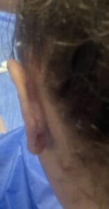 Protruding Bat Ears for Ear Pinning Surgery at Best Aesthetic Surgery Egypt