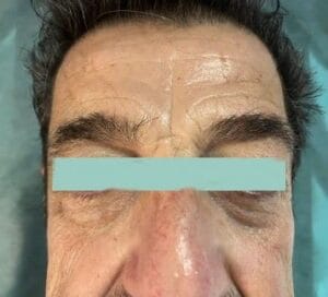 Deep Plane Endoscopic Facelift and Eyelid Surgery for face wrinkles and sagging at Best Plastic Surgery Egypt