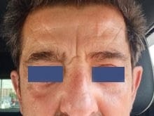 Deep Plane Endoscopic Facelift and Eyelid Surgery for face wrinkles and sagging at Best Cosmetic Surgery Egypt