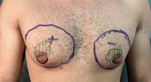 Asymmetric Male breast enlargement that had male breast reduction surgery at best Plastic Surgery Egypt