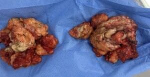 Asymmetric Male breast enlargement that had male breast reduction surgery at best Aesthetic Surgery Egypt