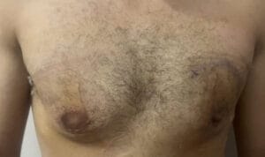 Asymmetric Male breast enlargement that had male breast reduction surgery at best Cosmetic Surgery Egypt