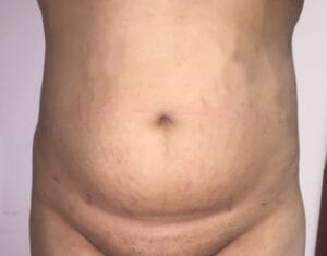 Fat Transfer and High Definition Smmart Vaser Liposuction of Belly to create Hourglass shape at Best Plastic Surgery Egypt