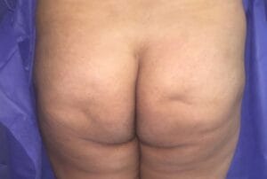 Fat Grafting and Brazilian Butt Lift to treat Butt Dips and Cellulite at Best Plastic Surgery Egypt