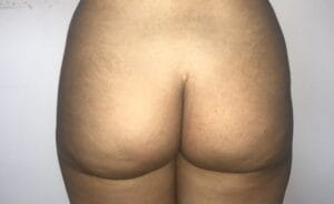 Fat Grafting and Brazilian Butt Lift to treat Butt Dips and Cellulite at Best Cosmetic Surgery Egypt
