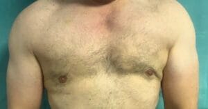 Male breast deformity after Gynecomastia Suurgery treated by Fat Transfer at Best Plastic Surgery Egypt